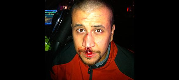 Zimmerman's bloody nose